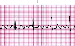 Atrial Flutter Pada Anak